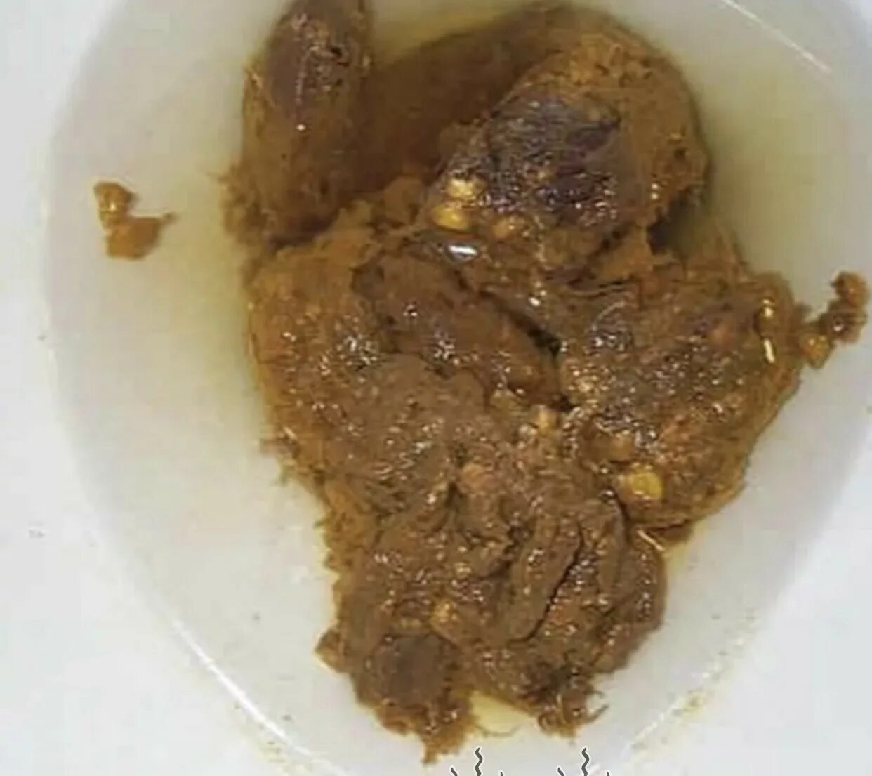 Диарея после жирного. Диарея после жирного. Диарея. Овечий стул у взрослого. Диарея после жирного.