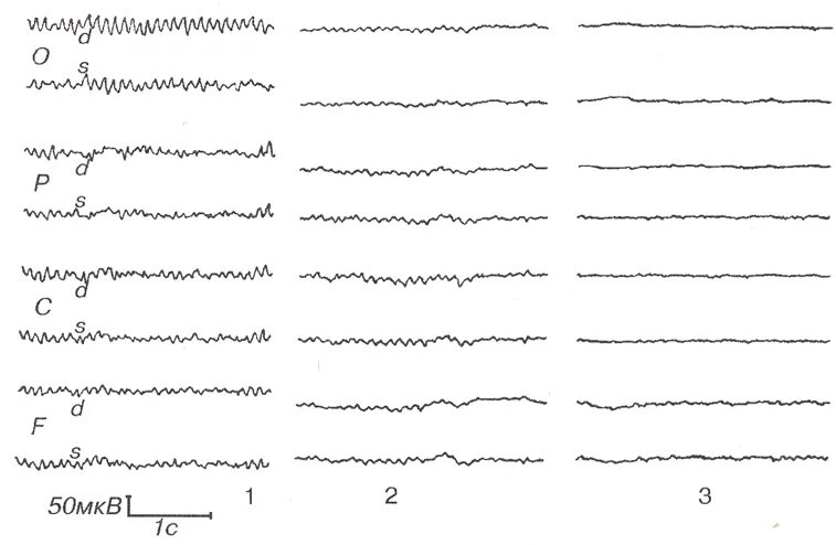 Низкоамплитудная ээг. ЭЭГ сигнал. Плоский Тип ЭЭГ. Низкоамплитудный Тип ЭЭГ на ЭЭГ. ЭЭГ нормальные показатели у взрослого.
