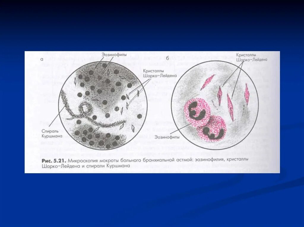 Спирали Куршмана, Кристаллы Шарко-Лейдена, эозинофилы. Спирали Куршмана и Кристаллы Шарко-Лейдена. Эозинофилия спирали Куршмана Кристаллы Шарко-Лейдена. Исследование мокроты Кристаллы Шарко Лейдена. Куршмана кристаллы шарко лейдена