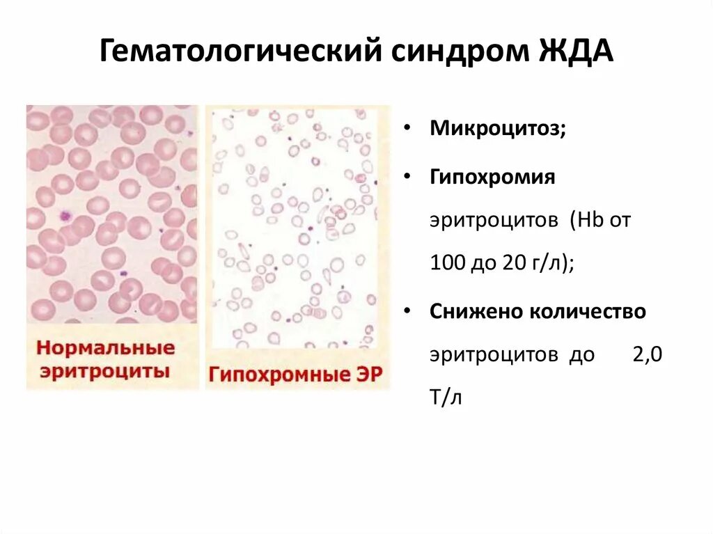 Пониженные макроциты. Железодефицитная анемия анализ крови микроцитоз. Гипохромия и микроцитоз характерны для. Микроцитарная анемия в анализе крови. Анизоцитоз,макроцитоз,пойкилоцитоз, гипохромия.