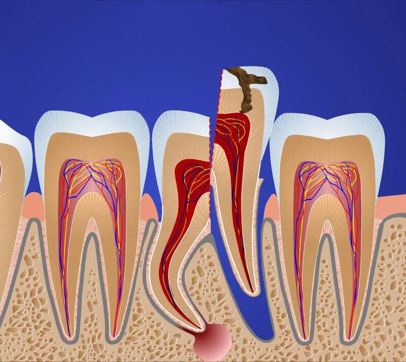 выдергивать ли коренной зуб