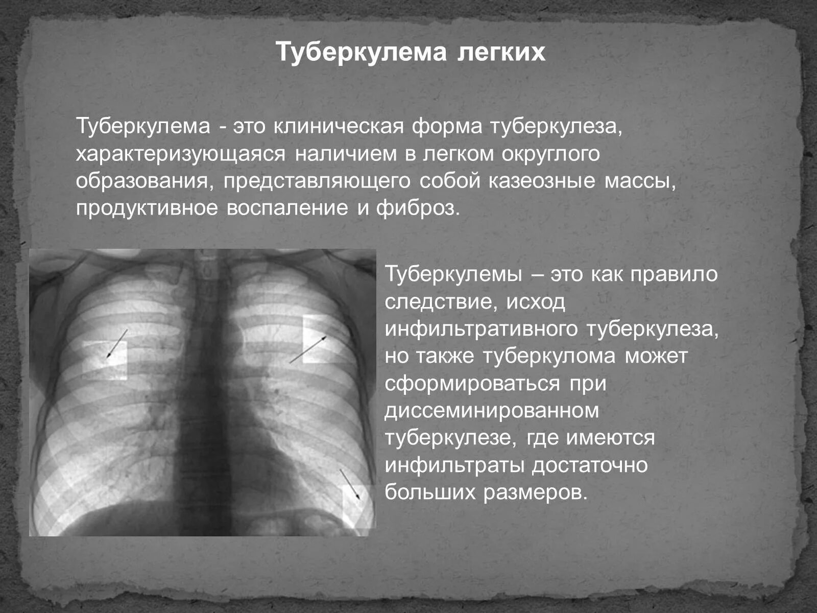 Как называли туберкулез. Туберкулема рентген описание. Рентген туберкулез туберкулема. Туберкулема рентген признаки. Туберкулема легких характеризуется.