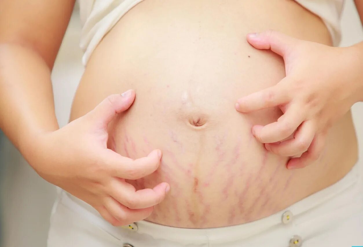 Во время беременности болит пупок. Живот на 28 неделе беременности. Животик болит. Пупок болуп приибеременности. Боль в области пупка у беременных.