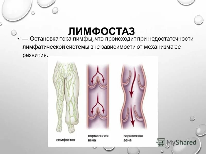 Нарушение лимфооттока. Лимфостаз и лимфедема патологическая анатомия. Нарушение лимфообращения: лимфостаз, лимфоотек слоновость. Лимфа нижних конечностей ног. Лимфатические отеки этиология.