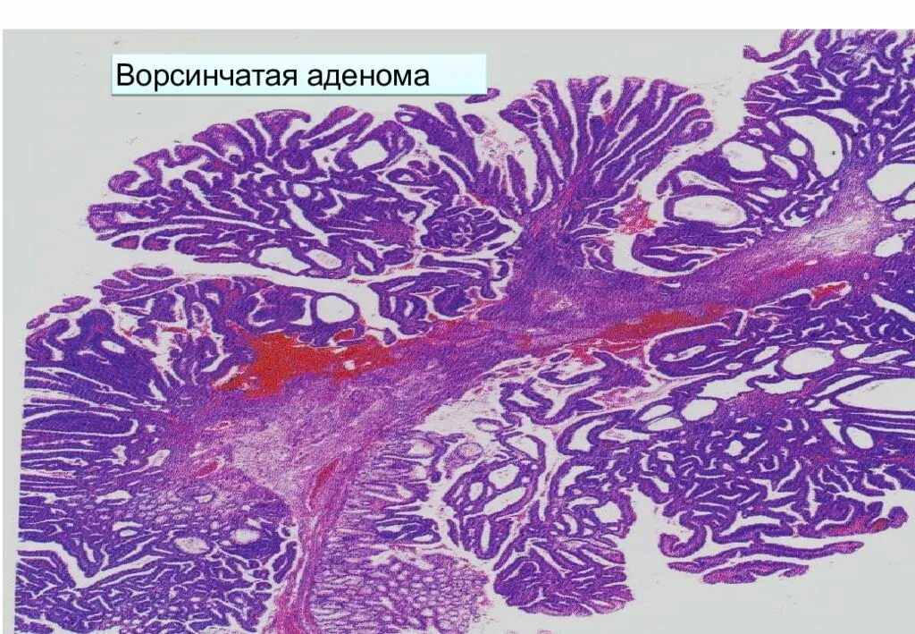 Ворсинчатая аденома гистология. Тубуло-ворсинчатая аденома. Ворсинчатая аденома прямой кишки. Ворсинчатая аденома толстой кишки. Тубулярная аденома толстой кишки что