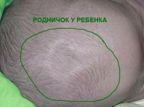 Родничок у ребенка 5 месяцев. Форма головы новорожденного родничок. большой и малый родничок у новорожденного. большой родничок в 4 мес норма.