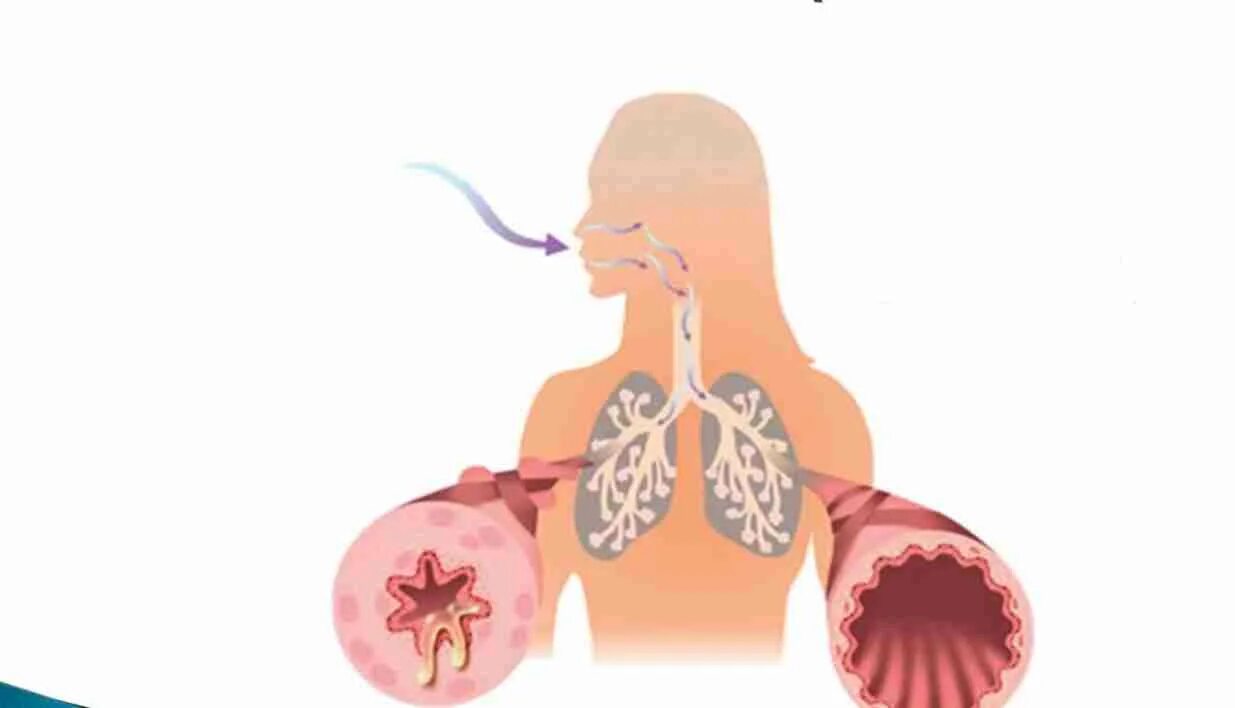 Почему ба. Сужение бронхов бронхоспазм. Лёгкие человека с бронхиальной астмой. Бронхит астма.