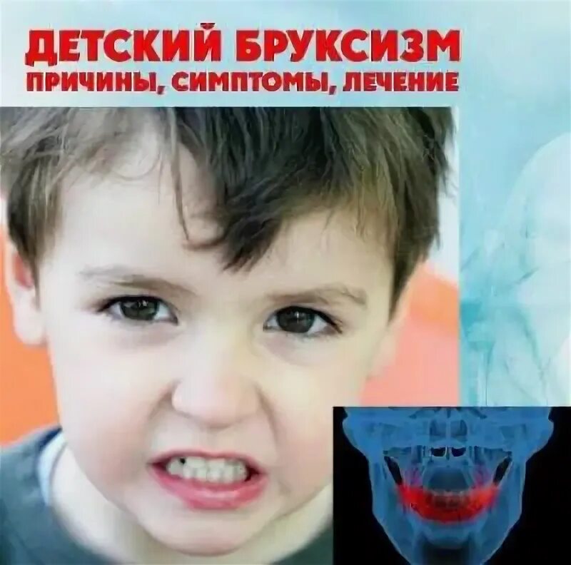 Бруксизм у детей причины. Бруксизм у детей причины