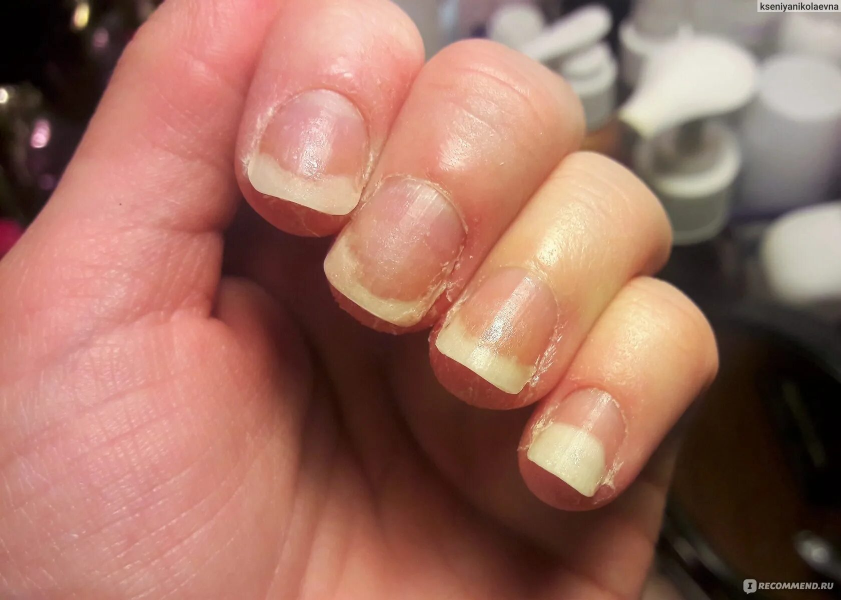 Pseudomonia is one of the diseases of the nails. It is caused by the bacterium P