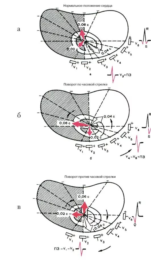 Сердце против часовой стрелки. Повороты сердца на ЭКГ вокруг продольной оси. ЭКГ поворот сердца продольной оси. Повороты сердца вокруг оси на ЭКГ. Определение поворотов сердца вокруг продольной оси.