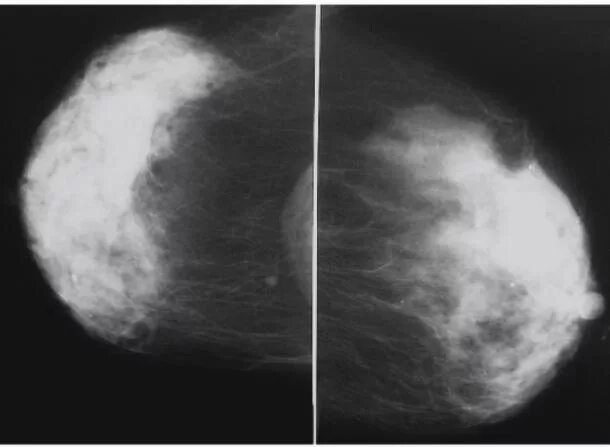 Маммография молочных желез 4. Узловая мастопатия молочной железы маммография. УЗИ мол.жел маммограмма. Фиброаденома молочной железы маммография. Снимки маммографии молочных желез в норме.