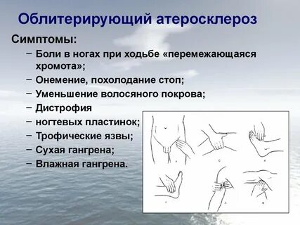 Облитерирующий атеросклероз профилактика