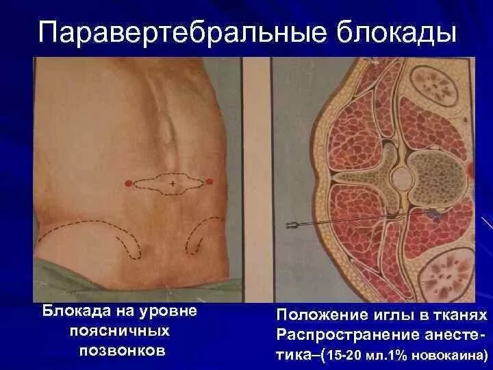 Паравертебральная поясничная блокада. Техника выполнения блокады поясничного отдела позвоночника. Паравертебральная блокада. Паравертебральной новокаиновой блокад..