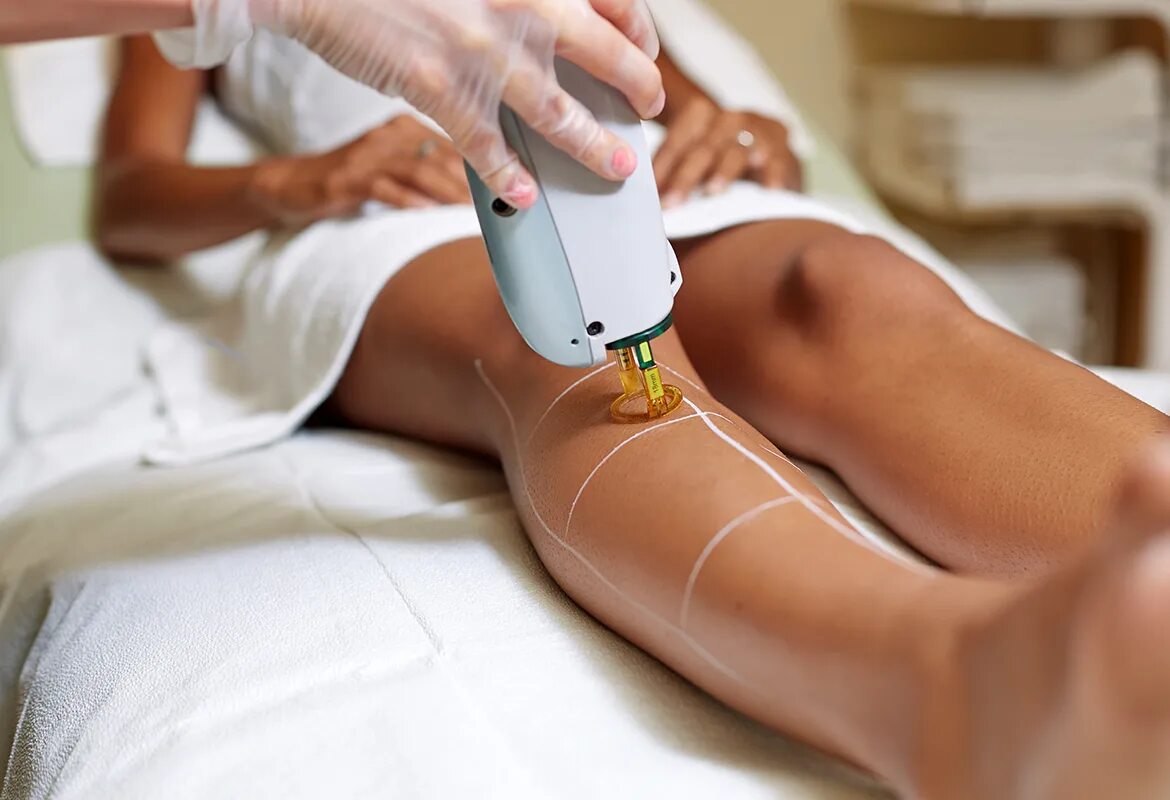 Перед лазерной депиляцией. Лазерная эпиляция Candela GENTLELASE. IPL Laser hair removal. Candela GENTLELASE Pro Alexandrite Laser hair removal. Эпиляция александритовым лазером.