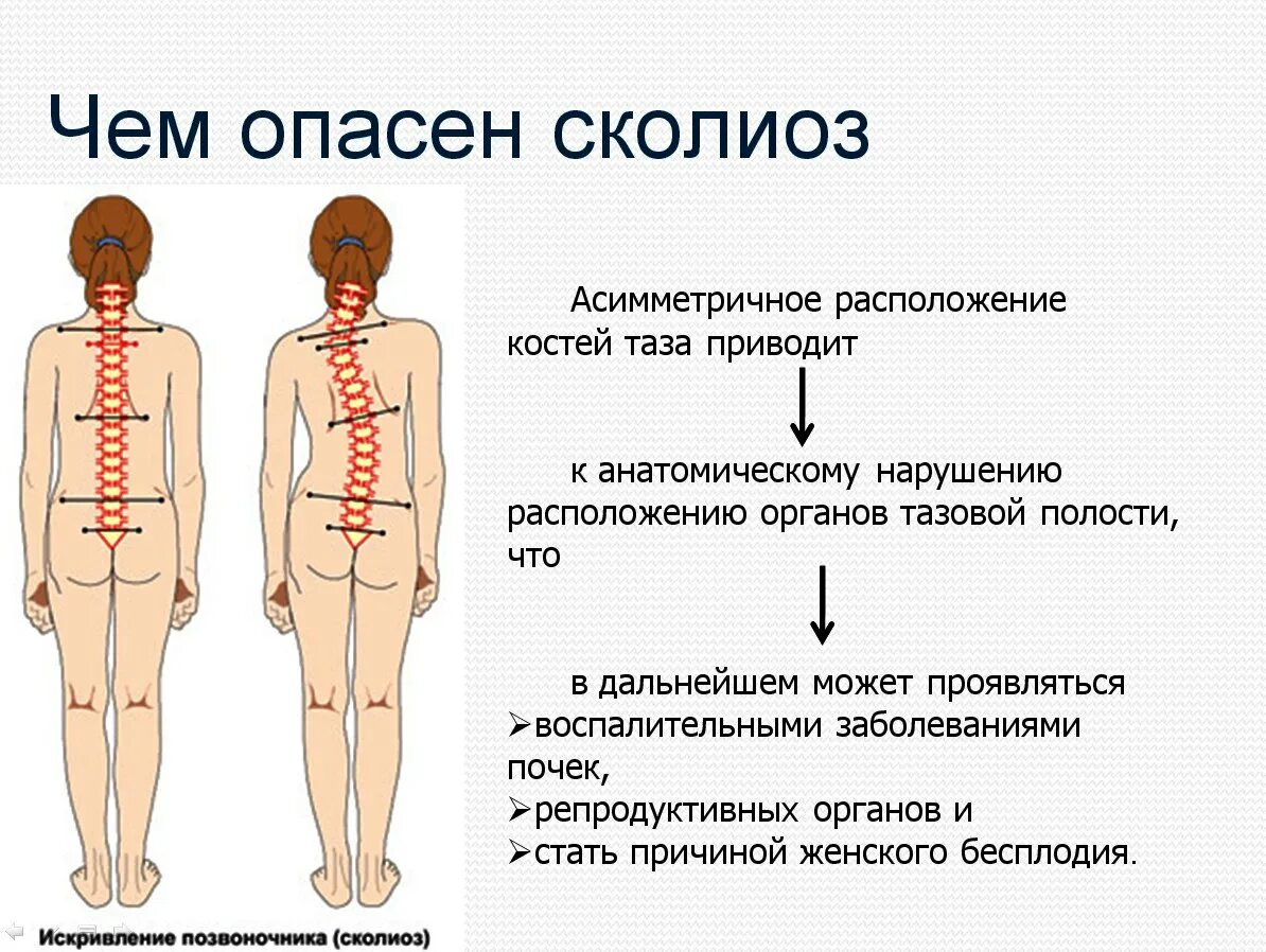 Сколиоз 2 степени это. Сколиоз позвоночника 1 степени. Искривление позвоночника 1 стадии. Поясничный сколиоз 1 степени. Дорсопатия поясничного отдела позвоночника.