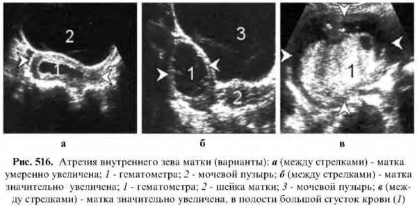 Матка расширена что это значит. Гематометра на УЗИ. Гематометра УЗИ картина. Гематометра гематосальпинкс.