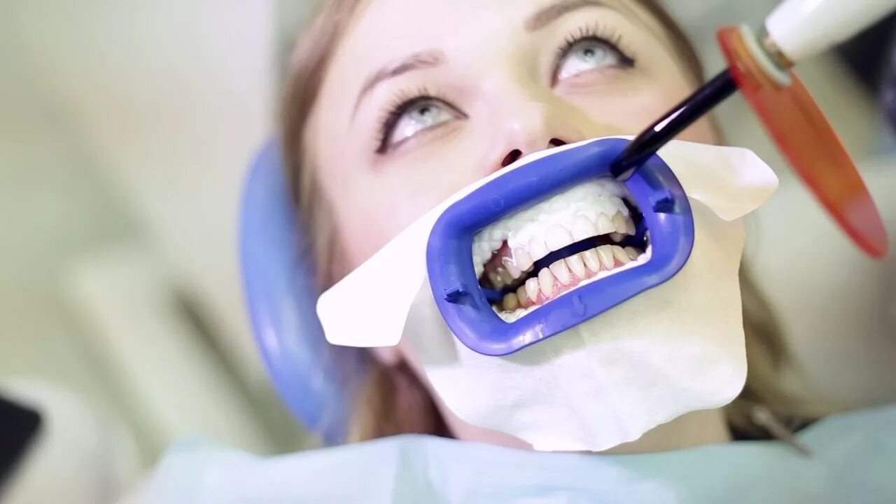 Можно курить после стоматолога. Отбеливание зубов в стоматологии. Отбеливание у стоматолога. Химическое отбеливание зубов. Стоматолог отбеливает зубы.