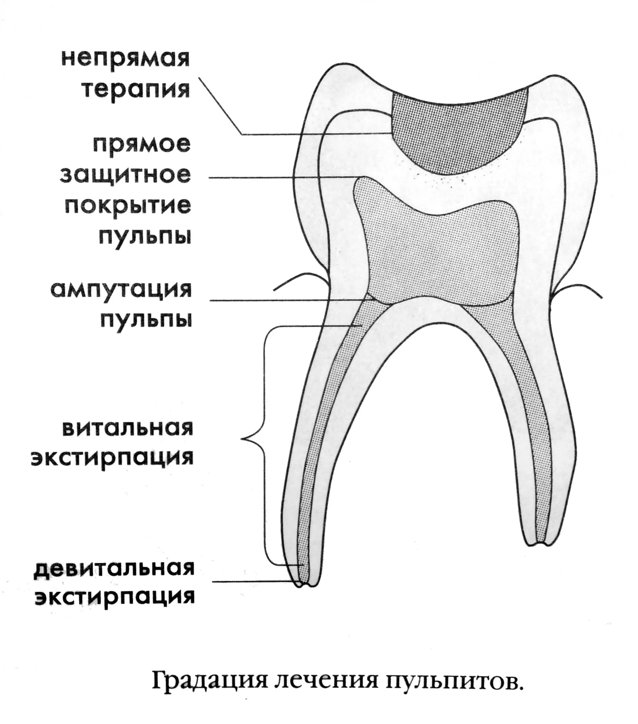 Витальная ампутация пульпы. Витальная ампутация пульпы этапы. Девитальная ампутация пульпы зуба. Этапы витальной ампутации пульпы (схема).. Витальная экстирпация пульпы методика.