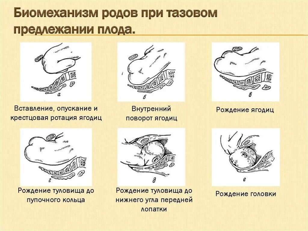 4 этапа рождения. 1. Биомеханизм родов при тазовом предлежании. Биомеханизм родов при чисто ягодичном предлежании. Механизм родов при тазовых предлежаниях таблица. Ягодичное предлежание биомеханизм родов.