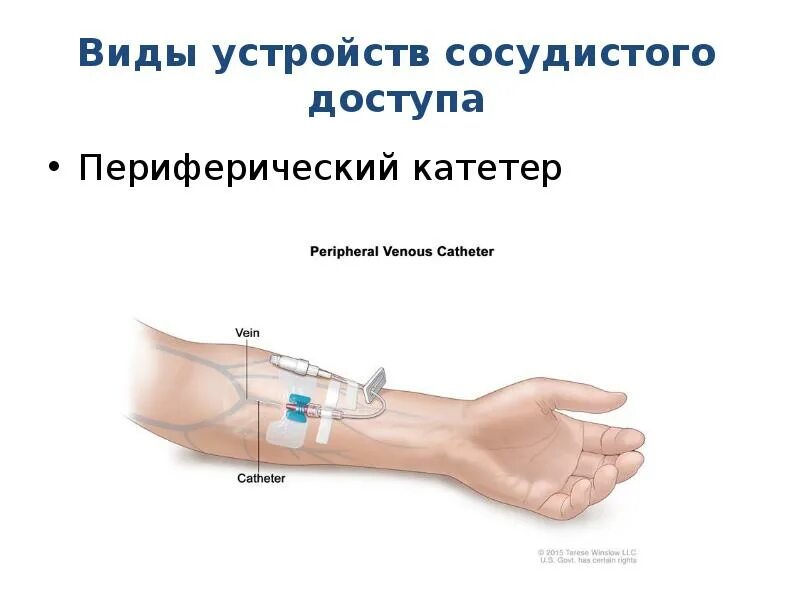 Постановка периферического венозного катетера. Уход за периферическим венозным катетером. Постановка периферического катетера алгоритм. Периферический венозный катетер алгоритм. Алгоритм постановки периферического венозного катетера