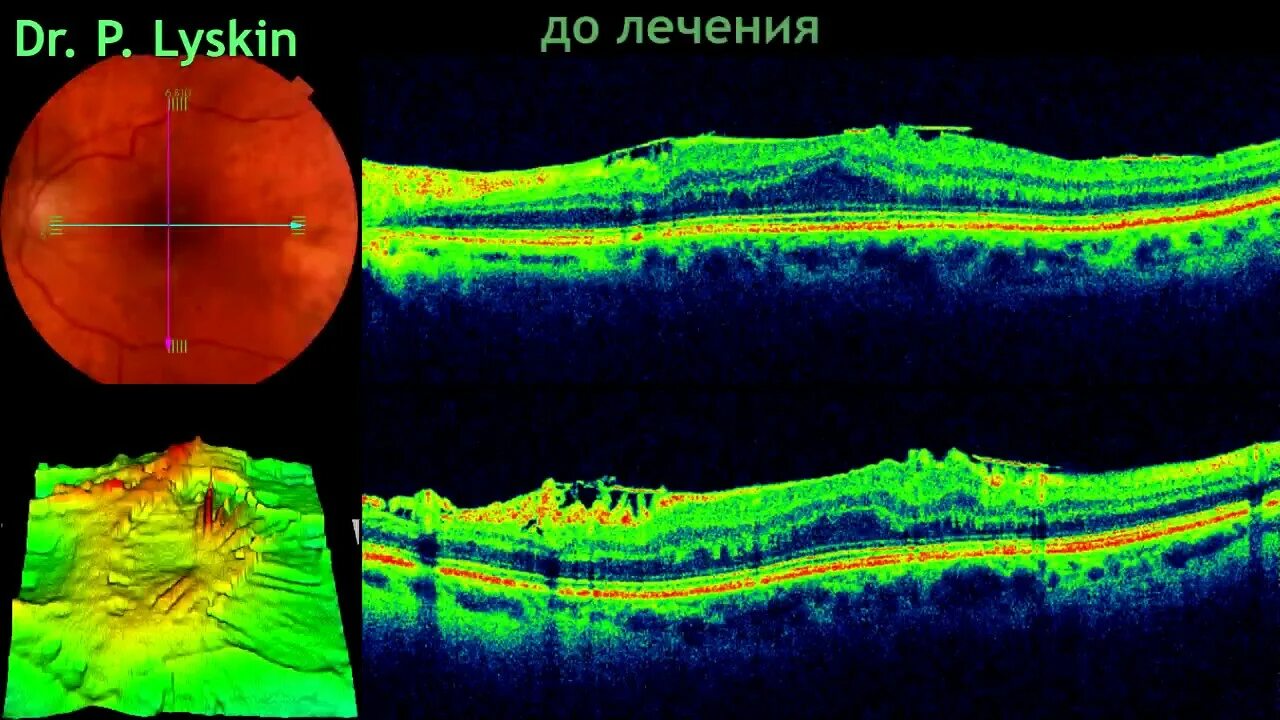 Эпиретинальный фиброз глаза что это. Макулярный фиброз сетчатки. эпиретинальная мембрана сетчатки. макулярная эпиретинальная мембрана. макулярный разрыв сетчатки.
