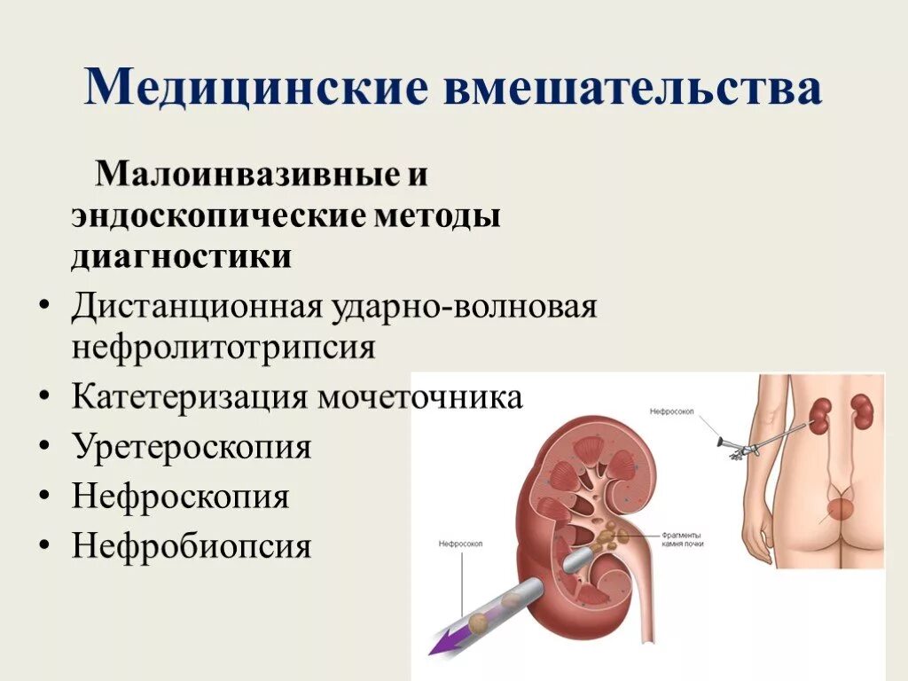 Катетеризация мочеточника. Катетеризирование мочеточника.