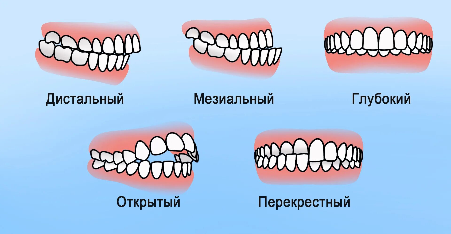 Почему зубы отличаются между собой. Правильный и неправильный прикус и челюсть. Правильный прикус зубов у человека. Правильный прикус зубов у человека и неправильный. Прикус зубов правильный прикус.