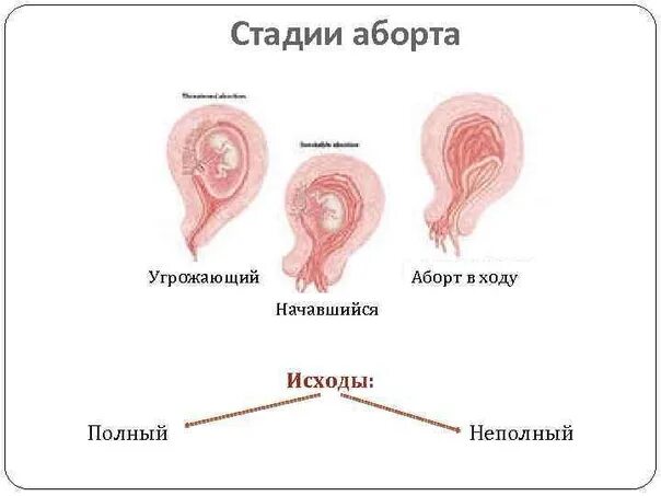 Занималась Сексом После Медикаментозного Прерывания