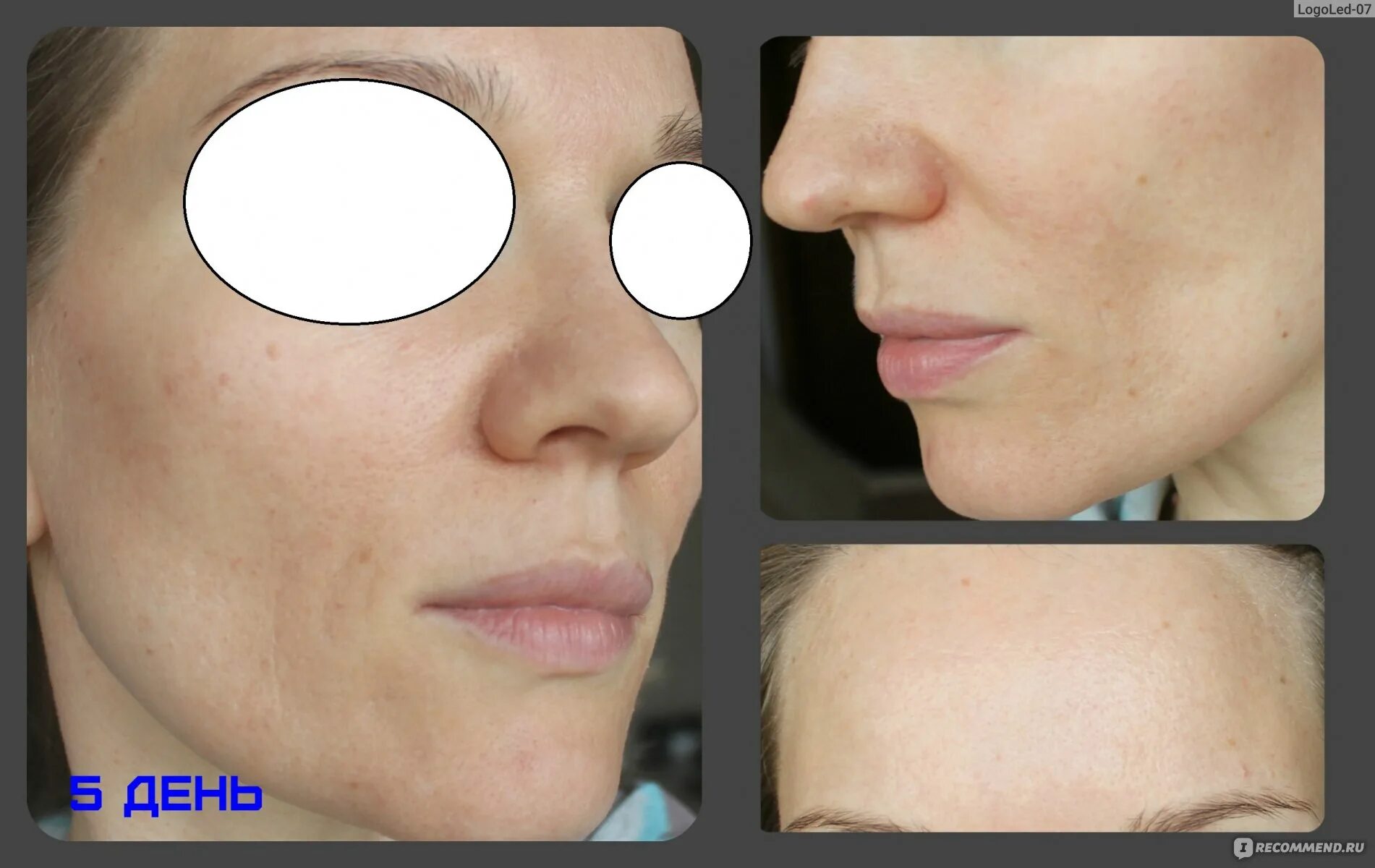 Прх т33 пилинг. T33 пилинг отзывы. T33 пилинг отзывы. Пилинг prx-t33. Пилинг prx-t33 протокол.