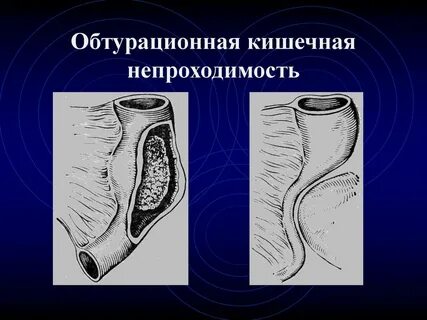 Острая обтурационная толстокишечная непроходимость