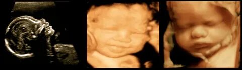 Жүктіліктің 20 аптасындағы 3D ультрадыбыстық фотосурет