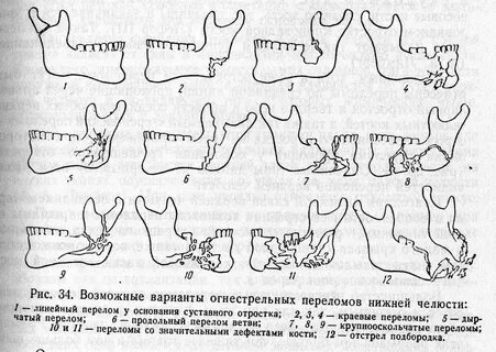 Перелом сустава нижней челюсти