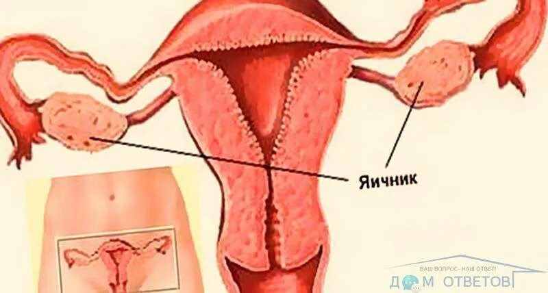 Удаление яичника можно забеременеть после. Яичники у женщин.