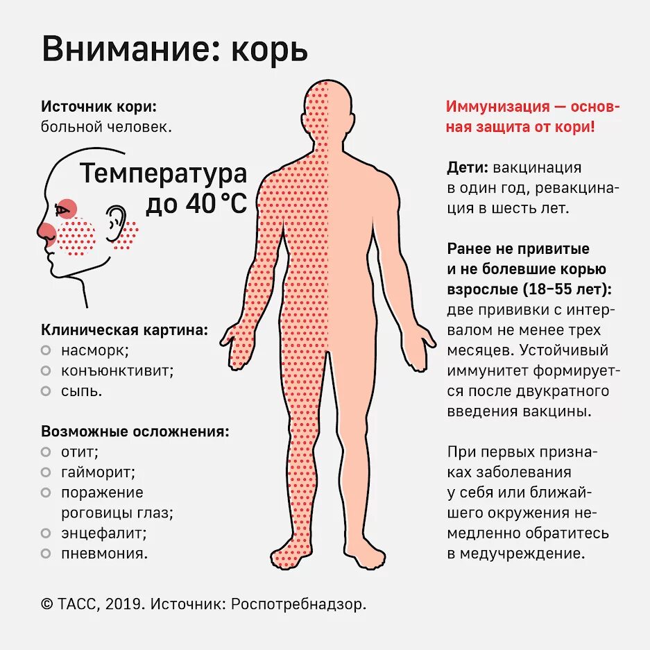 Корь симптомы и лечение. Признаки кори корь симптомы.