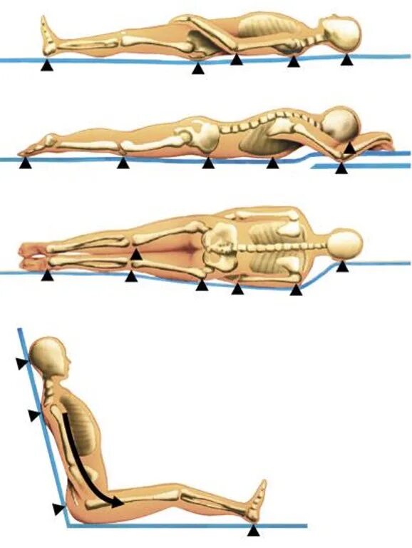 Положение позвоночника лежа на спине. Зоны риска развития пролежней. Места образования пролежней сидя. Места образования пролежней на спине. Места образования пролежней у пациента лежащего.