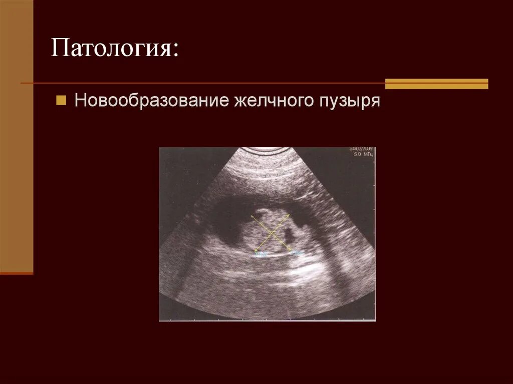 Отекает желчный пузырь. Новообразование желчного пузыря. Новообразование в желчном пузыре на УЗИ. Неоплазия желчного пузыря. Опухоль желчного пузыря на УЗИ.