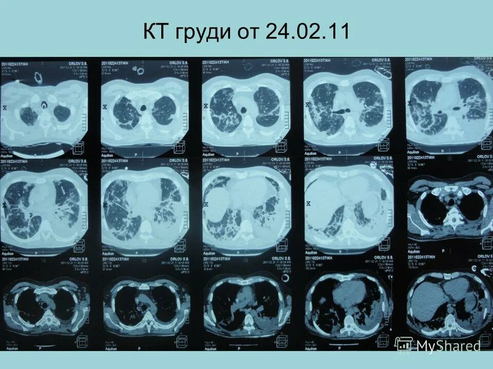 образование в молочной железе на кт. снимок кт грудной клетки. магнито-резонансная томография молочной железы. аденоз молочных желез мрт. фиброаденома молочной железы мрт.