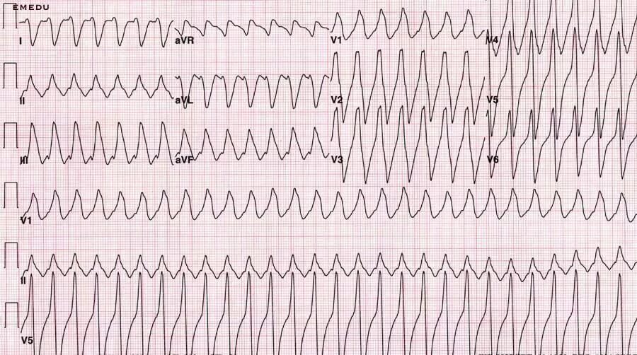 Желудочковая тахикардия на экг. Тахикардия желудочков на ЭКГ. Левожелудочковая тахикардия ЭКГ. Пароксизмальная мономорфная желудочковая тахикардия.