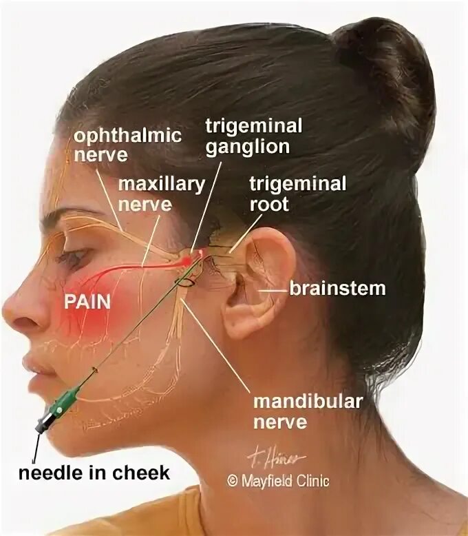 Neuralgia латынь. Тройничный нерв на лице фото. trigeminal neuralgia. воспаление тройничного нерва на лице фото. тройничный нерв на лице.