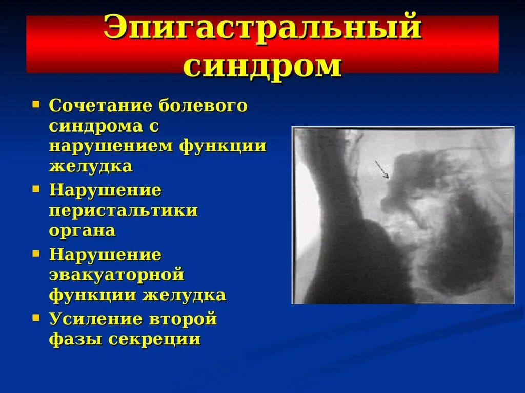Нарушение функционирования органа. Эпигастральный болевой синдром. эпигастральный болевой синдром по панкреатическому. синдром нарушения эвакуаторной функции желудка. синдром нарушения функции органа.