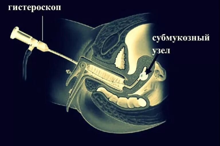 Миома матки гистероскопия. Субмукозная миома гистероскопия. Гистероскопия показания. . Гистероскопия (субмукозные узлы).. Гистероскопия операция удаления полипа