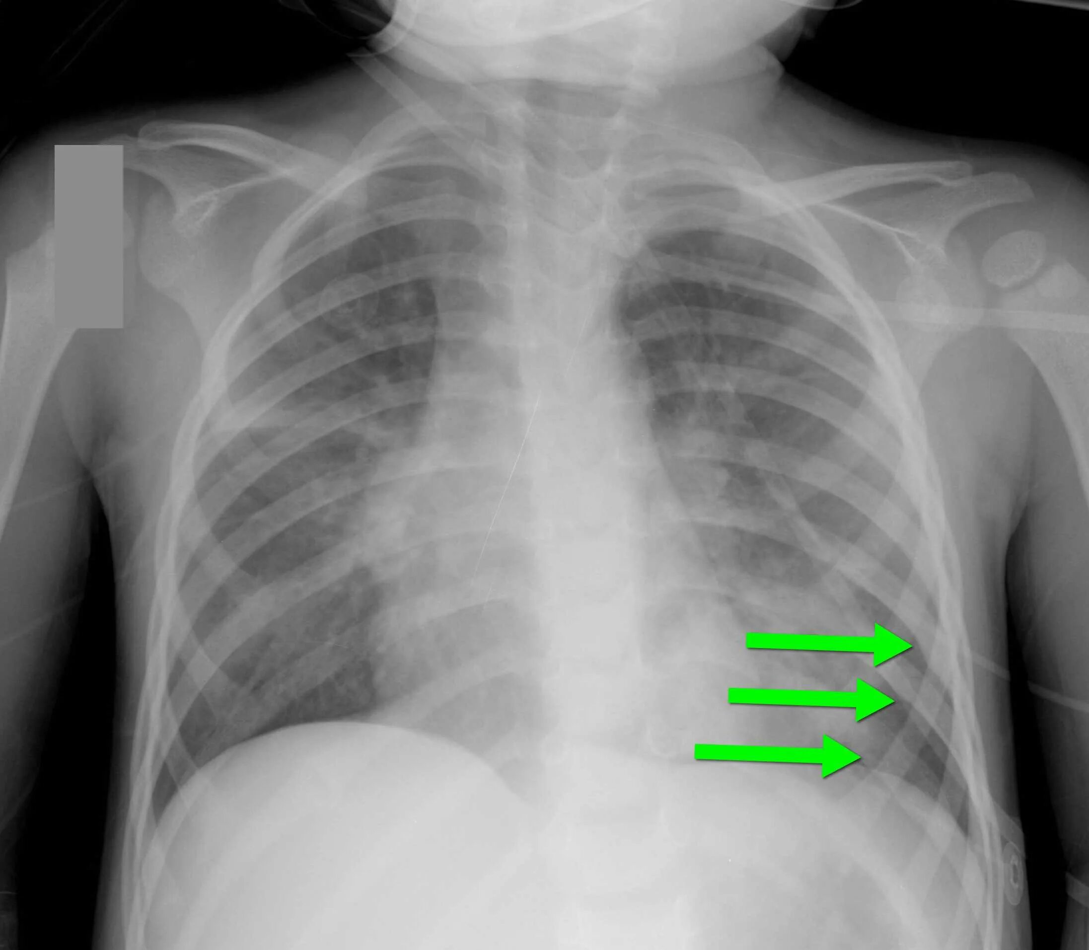 Перелом грудной клетки рентген. Рентген перелом ребра слева. Сращение ребер рентген.