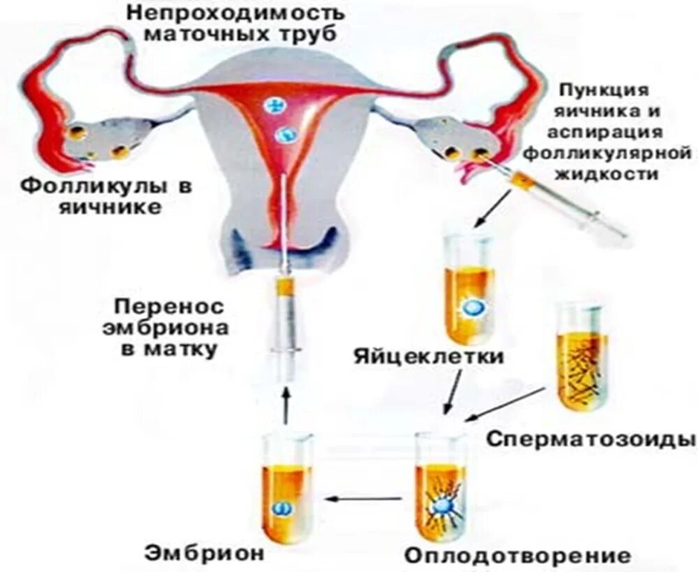 Пункция забора яйцеклетки. Эко это искусственное оплодотворение. Уколы после пункции фолликулов. Перенос эмбриона в матку. Боли после пункции фолликулов