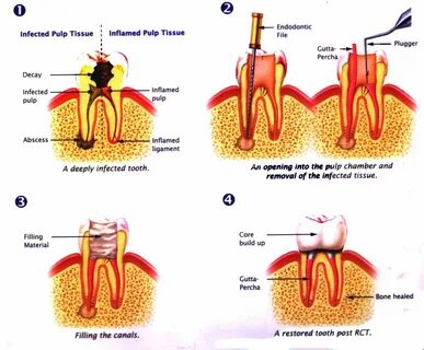 Summary of Root Canal Treatment 