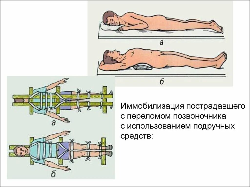 Повреждение позвоночника необходимо. Перелом позвоночника иммобилизация. Транспортная иммобилизация при переломе позвоночника. Иммобилизация пострадавшего с переломом позвоночника. Иммобилизация при переломе позвоночника на щите.