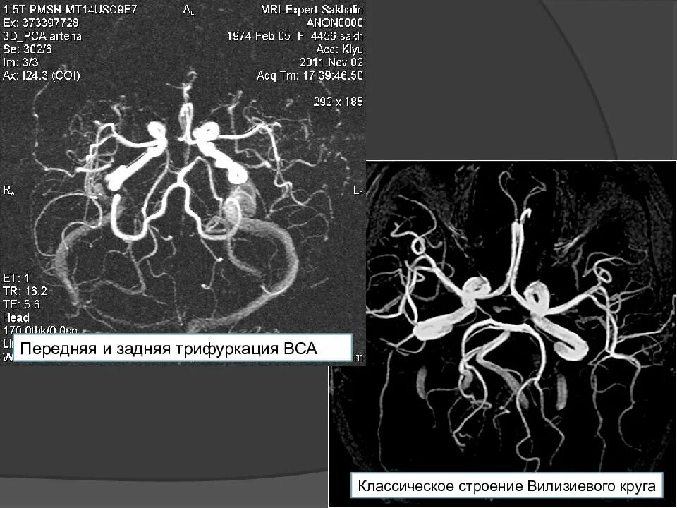 Передняя трифуркация левой ВСА кт. Трифуркация мрт. Неполная задняя трифуркация артерии мрт. Варианты развития Виллизиева круга кт.