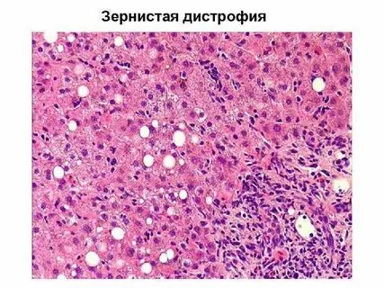 Белковая дистрофия печени