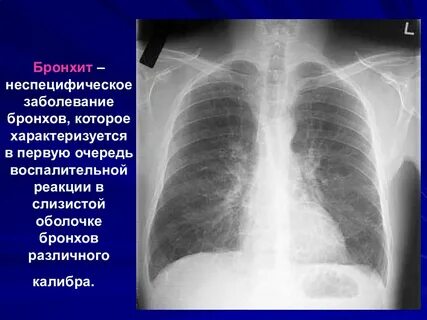 Последствия фиброза легких