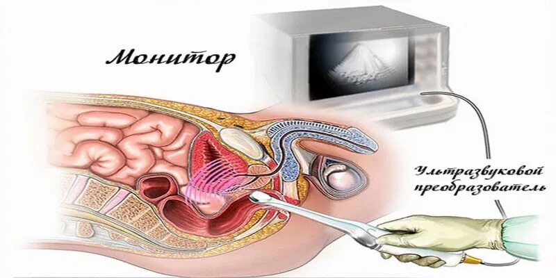 Трузи предстательной железы подготовка к исследованию. Трансректальное УЗИ предстательной железы. УЗИ трузи предстательной железы. Трансабдоминальное УЗИ предстательной железы. УЗИ предстательной железы трансректальным датчиком.