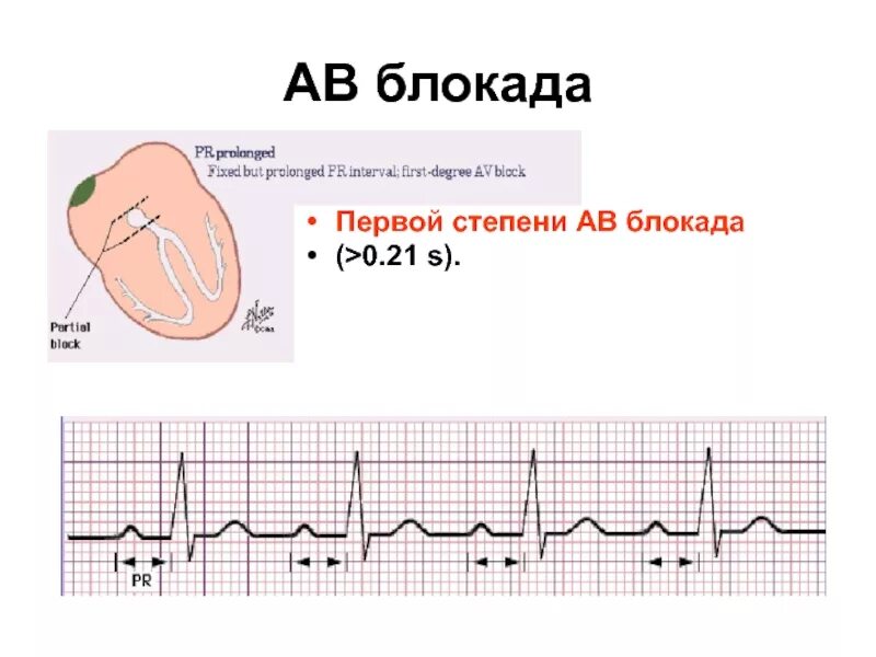 Аве блокада сердца 1 степени. Аб блокада 1 степени на ЭКГ. АВ-блокада 1 степени сколько клеток. Атриовентрикулярная блокада 1 степени у собак.